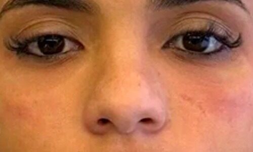 Botox