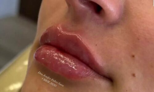Preenchimento Labial